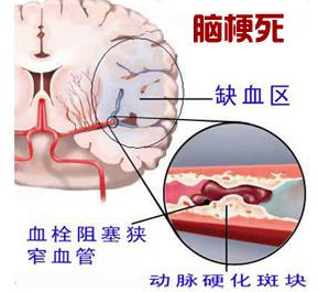 中医爱好者杨先生使用文山三七为朋友改善脑梗